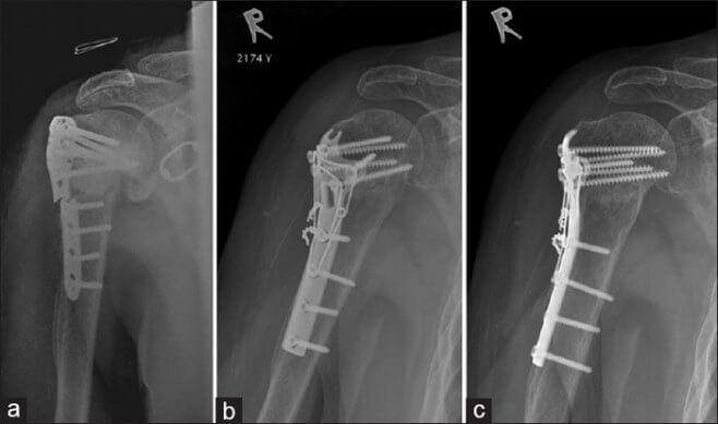 perelom-shejki-plecha (4)