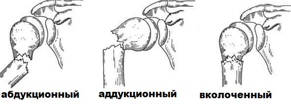 perelom-shejki-plecha (7)