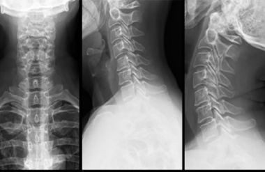 Сильно болит спина от лопаток до поясницы