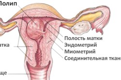 Полип матки - причина задержки месячныхi Полип матки - причина задержки месячныхi