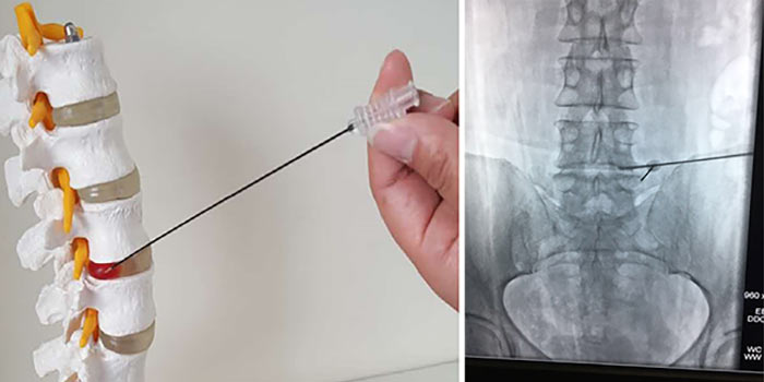 метастазы в печени болит спина