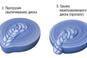 Стадии развития межпозвоночной грыжи Стадии развития межпозвоночной грыжи