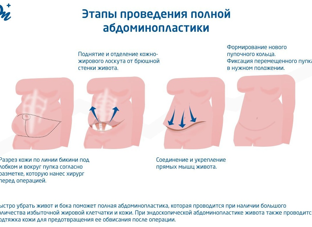 Почему у женщин растет живот после 35: кортизоловое и абдоминальное ожирение — что это и как лечить
