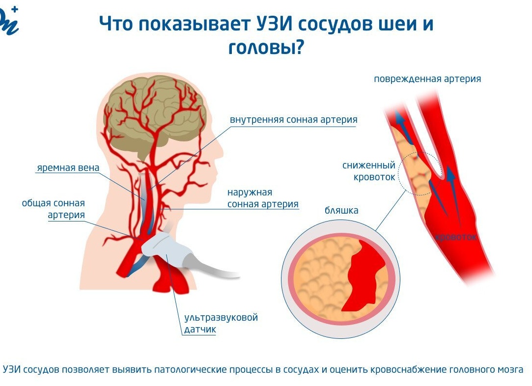 ЧТО ПОКАЗЫВАЕТ УЗИ СОСУДОВ ШЕИ?