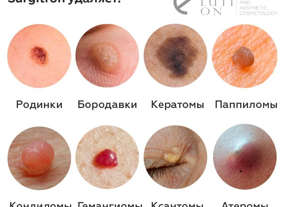 Папиллома, бородавка, кератома, фиброма – как отличить: объясняет дерматолог