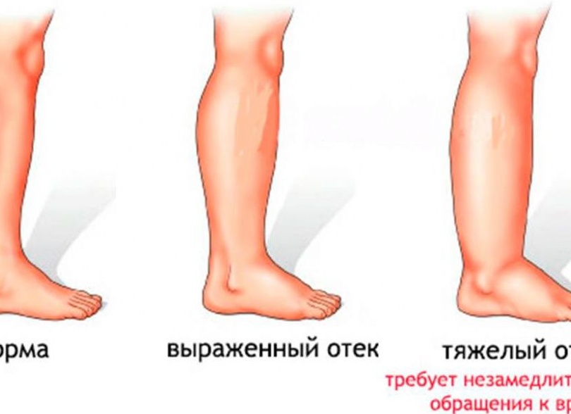 Почему отекают ноги и что делать?